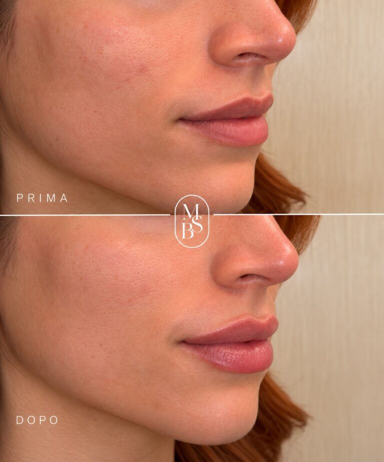 Filler labbra: definizione e armonia, senza stravolgere